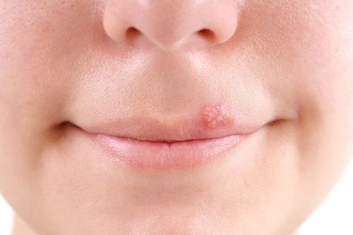 Symptoms of Cold Sores - Causes and Stages Explained